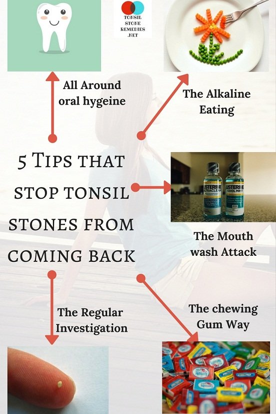 5 Tips that stop tonsil stones from coming back
