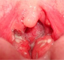 Treat Swollen Tonsils, swollen tonsils treatment, swollen tonsils home remedy, swollen tonsils pictures