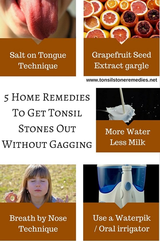 5 Home Remedies To Get rid of Tonsil Stones Without Gagging