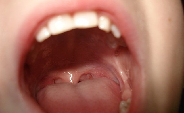 white lump on tonsil
