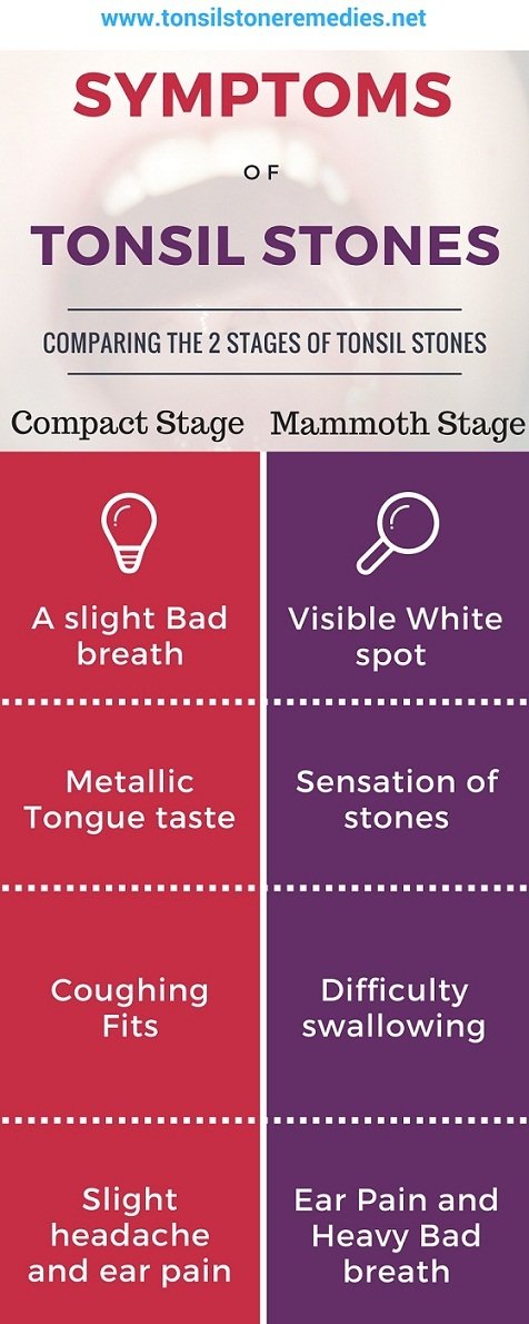 Tonsil stone symptoms Which stage are you at