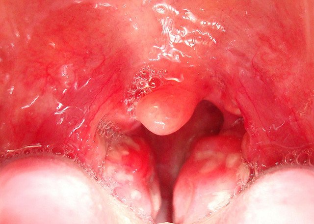 The white lumps caused by tonsillitis