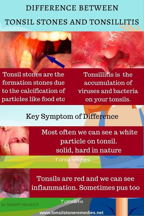 Difference between tonsil stones and tonsillitis