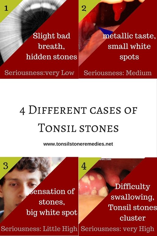 knowing your tonsil stones dangerous-ness and harmful-ness based