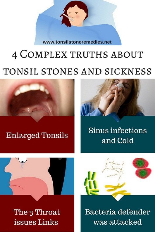 4 Complex truths about tonsil stones and sickness