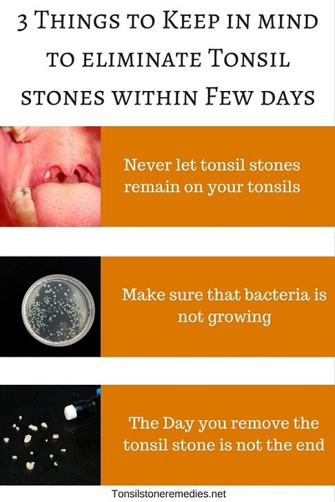 3 Things to Keep in mind to eliminate Tonsil stones within Few days
