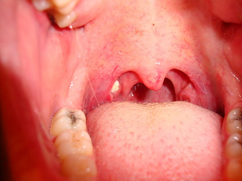 how long tonsil stones take to last