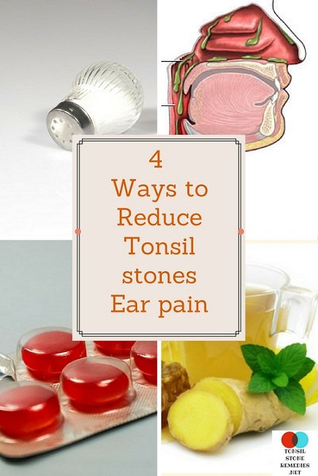 4 Ways to Reduce Tonsil stones ear pain