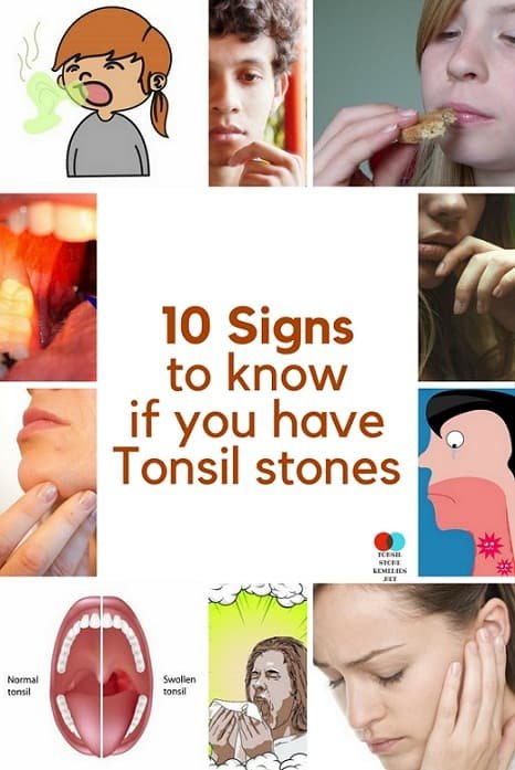 How do you know if you have Tonsil stones? The 10 Signs