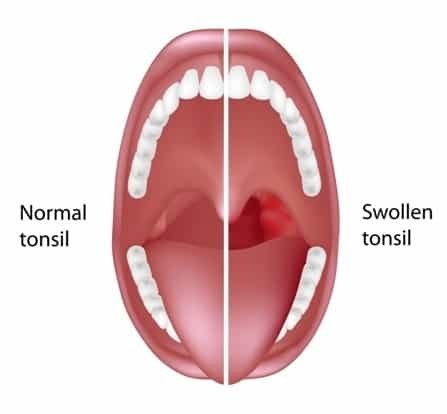 How to tell if you have tonsil stones by swollen tonsils