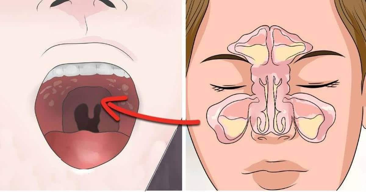 sinus and tonsil stones how to get rid of them