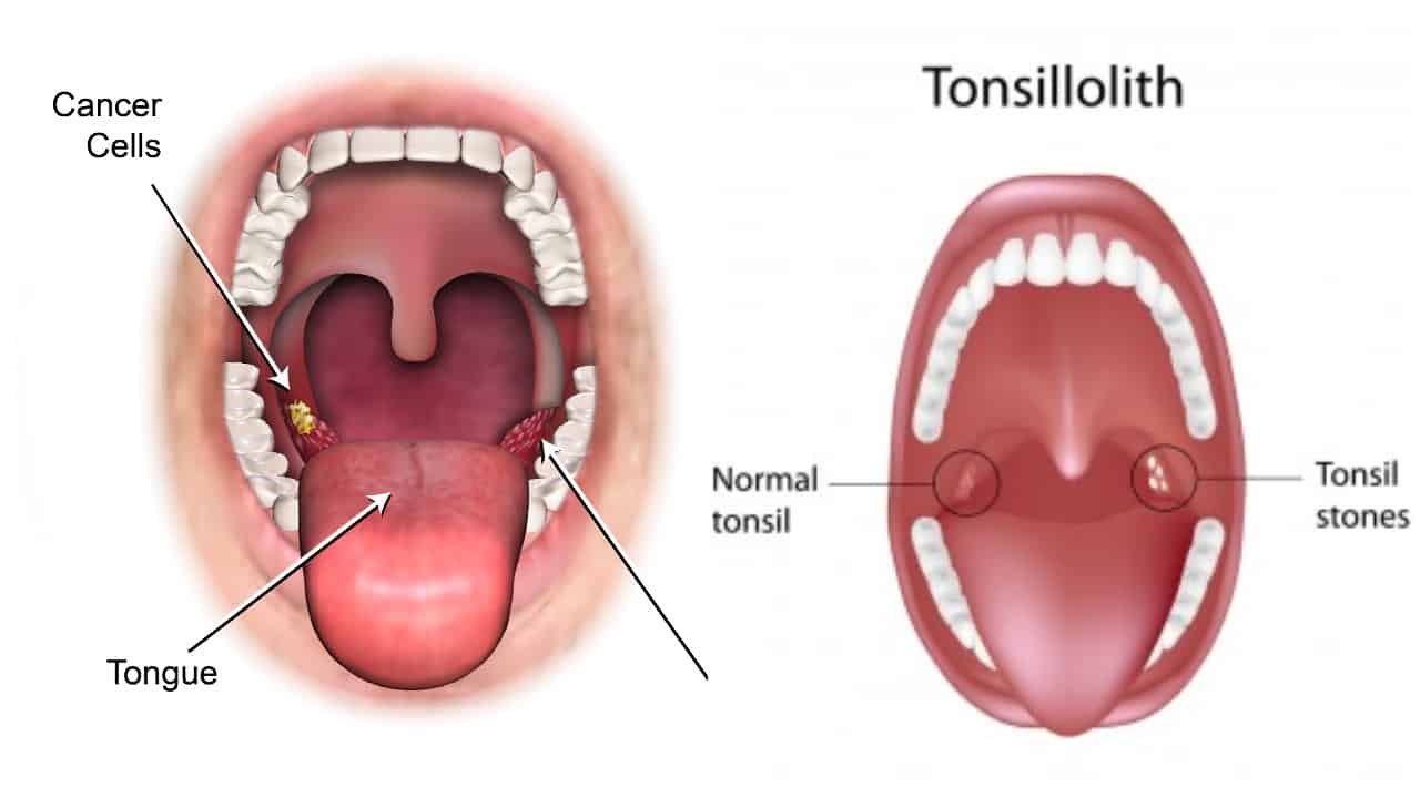 Can Tonsil stones cause cancer? Scarily, is it possible?