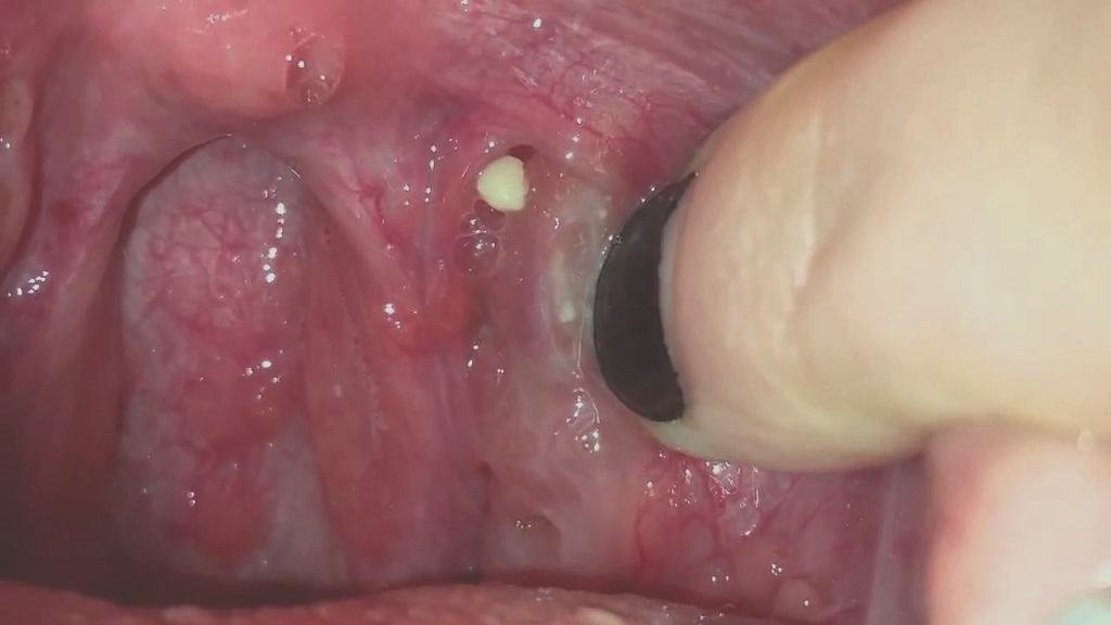 tonsil stones in hole
