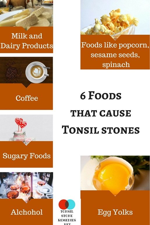 6 Foods that cause Tonsil stones – Here is the List you must avoid
