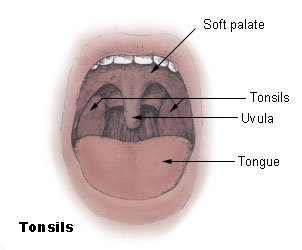 tonsillectomy for tonsil stones