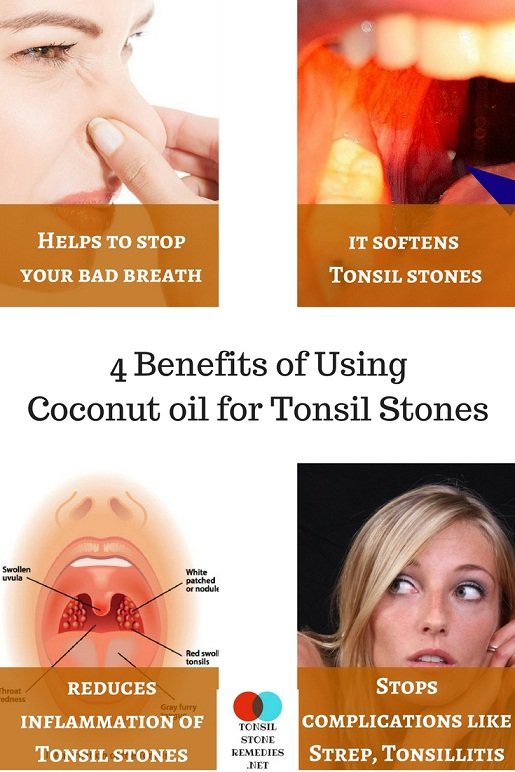 Coconut oil for Tonsil stones: Does oil pulling really eliminate your stones?