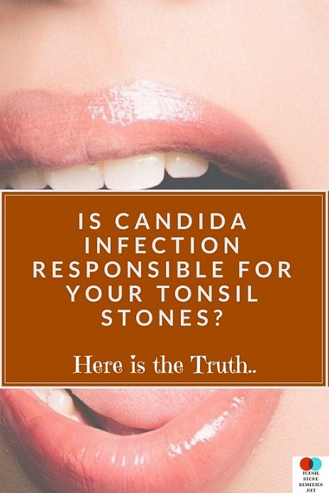 Is Candida infection responsible for your Tonsil stones? Here is the Truth