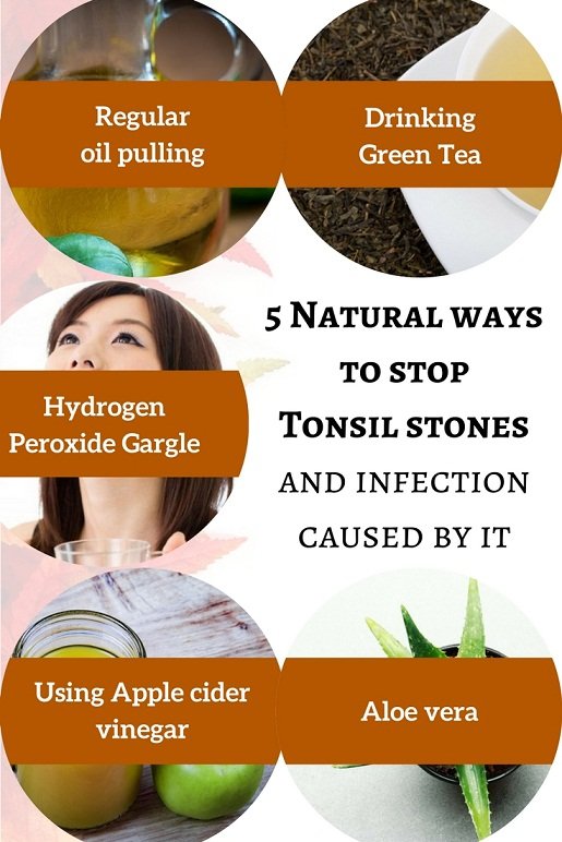 Can Tonsil stones cause infection? 5 Natural ways to stop it