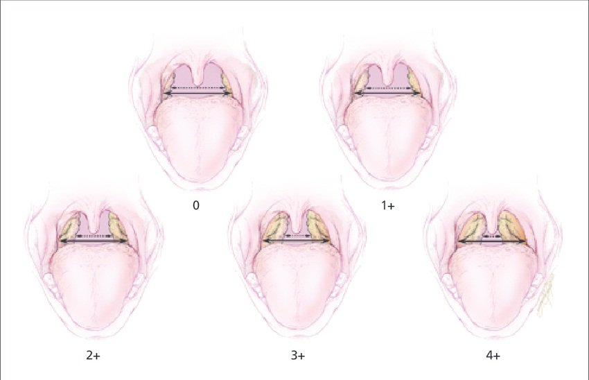 Tonsillar hypertrophy