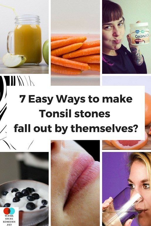 How to make Tonsil stones fall out by themselves? The 7 Easy ways