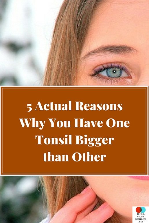 5 Actual Reasons Why You Have One Tonsil Bigger than Other