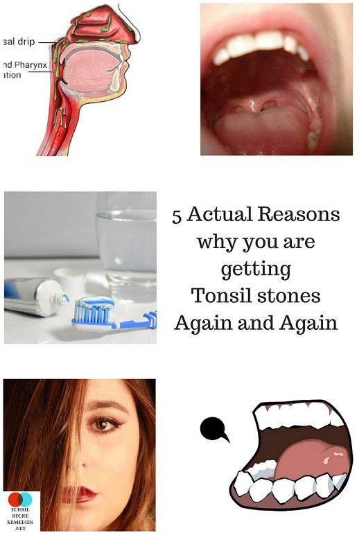 "Why do I keep getting Tonsil stones?" Here are the 5 Actual reasons