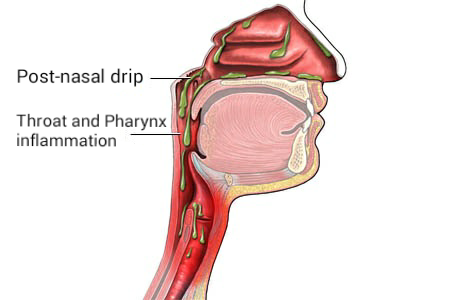 post nasal drip and recurring tonsil stones