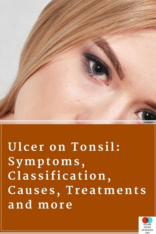 Ulcer on Tonsil Symptoms, Classification, Causes, Treatments and more
