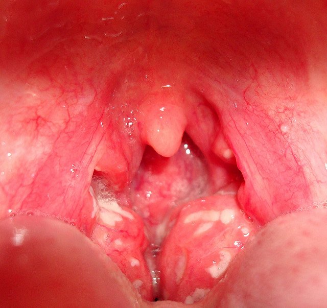 tonsillitis pictures and images