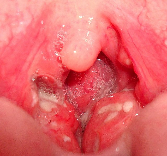 pictures of tonsillitis in throat