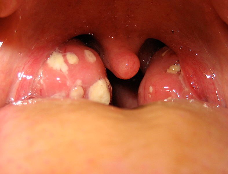 tonsillitis images