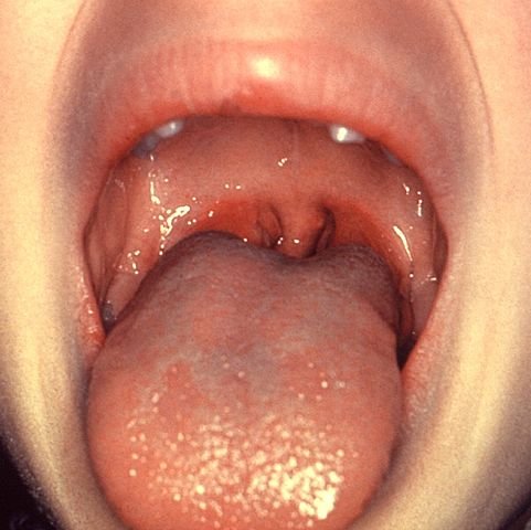 tonsillitis real images of people