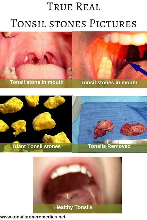 Tonsillitis Tonsil Stones