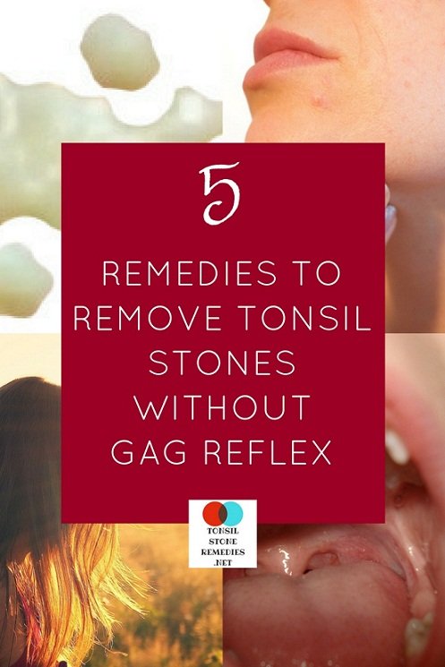 How To Remove Tonsil Stones At Home Without Gagging