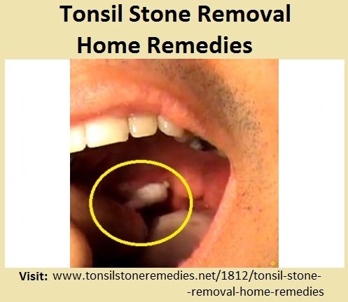 Tonsil Stone Removal Home Remedies