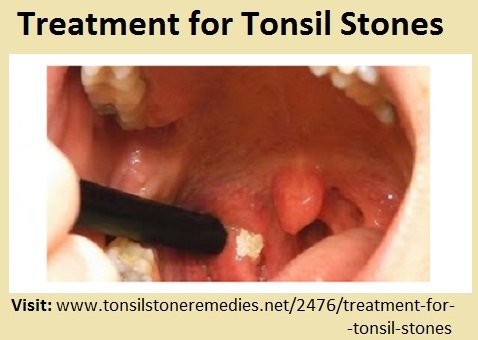 Treatment for Tonsil Stones