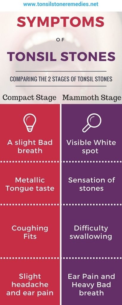 A Clear cut Tonsil stones diagnosis and its symptoms in your throat