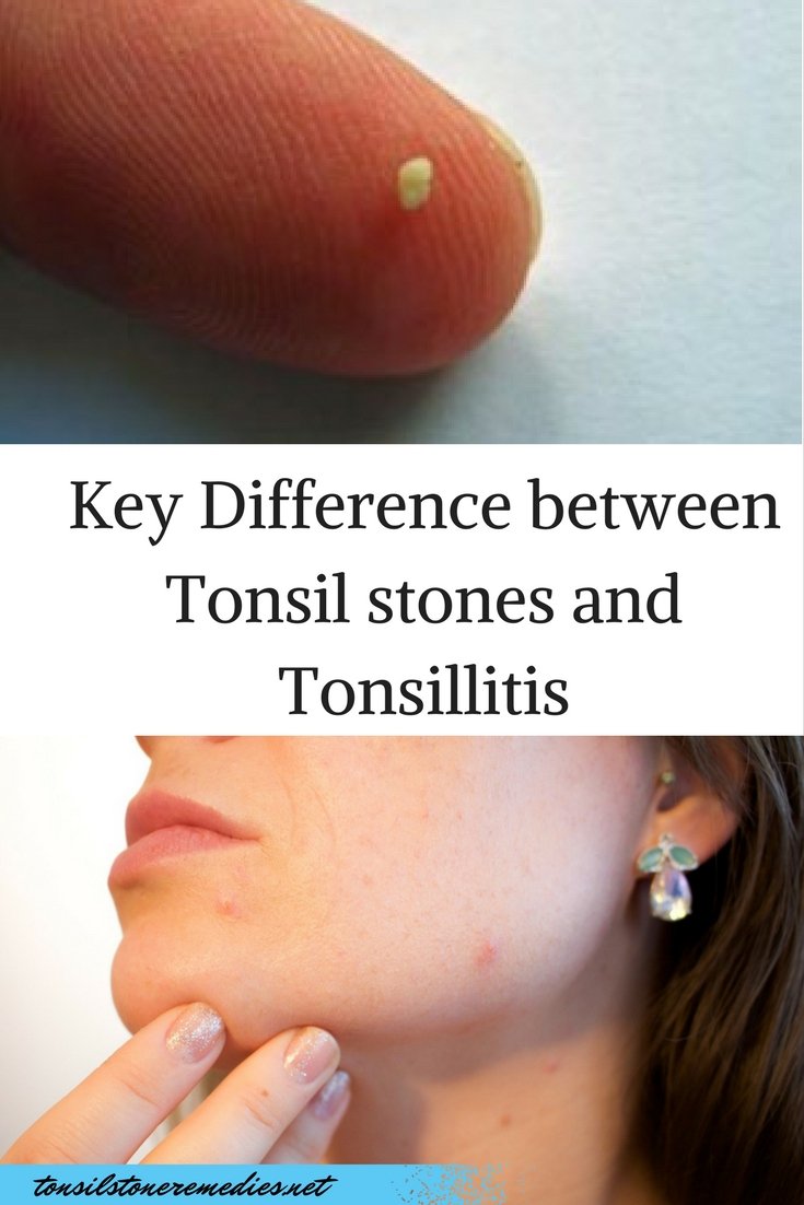 do-you-know-the-key-difference-between-tonsil-stones-and-tonsillitis