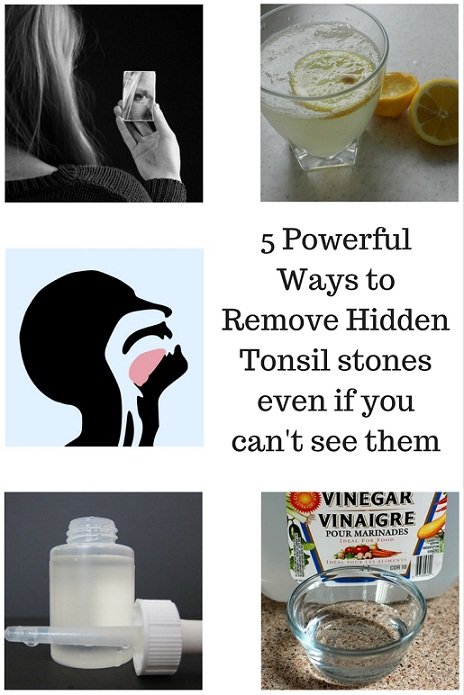 5 Powerful Ways to Remove Hidden Tonsil stones even if you can't see them