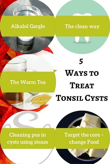 5 ways to treat tonsil cysts - A complete guide for tonsil cysts