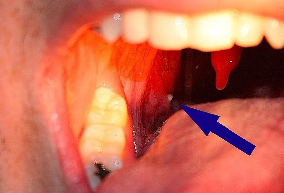 white spot in throat during pregnancy