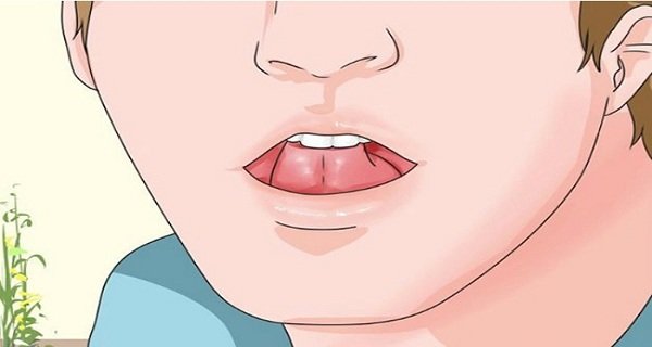 tonsil stones tongue