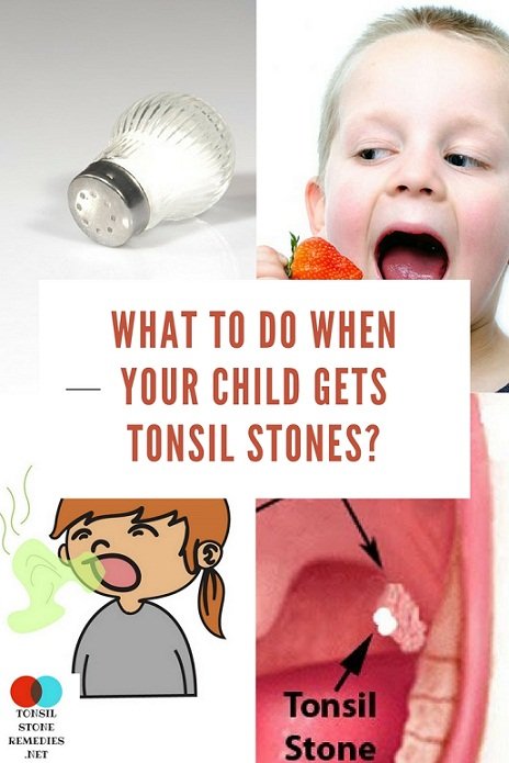 how do you get rid of tonsil stones in a child