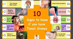 10 signs to know if you have tonsil stones