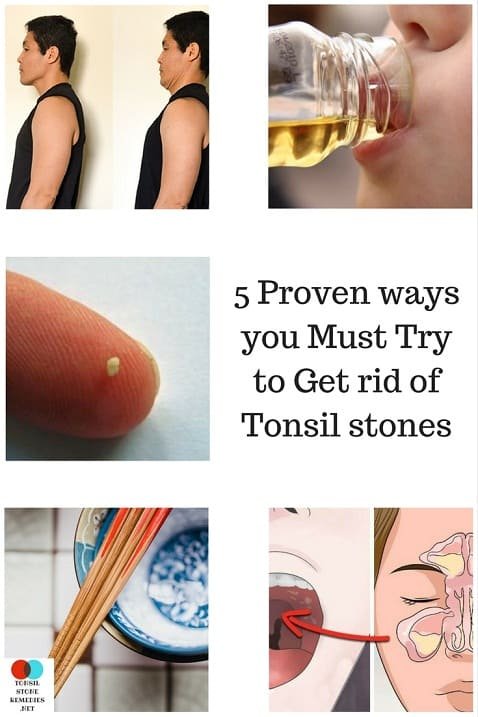 How to get rid of Tonsil stones? 5 Proven ways you Must Try