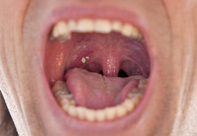 tonsil stone in throat