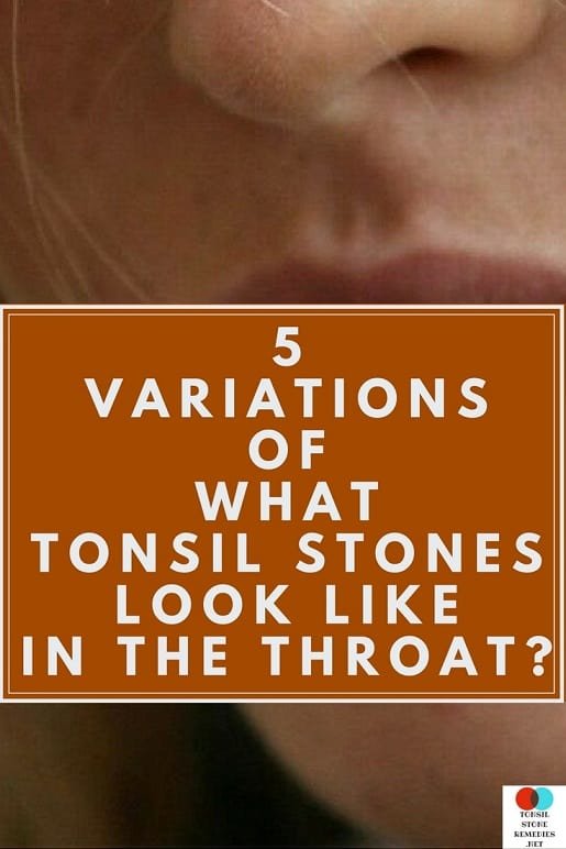 what do Tonsil stones look like in the throat? The 5 Variations