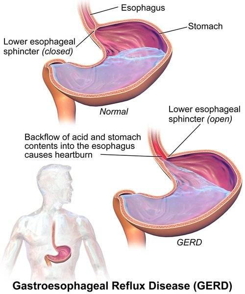 acid reflux and tonsil stones