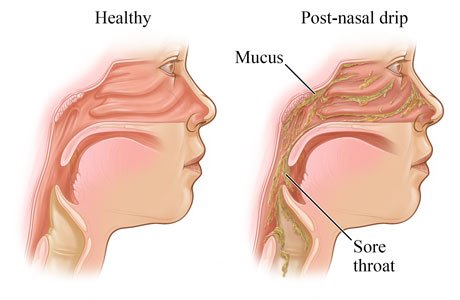 acid reflux post nasal drip and tonsil stones