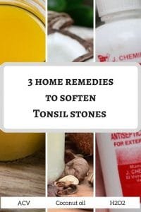 Are Tonsil stones hard or soft when you touch them?